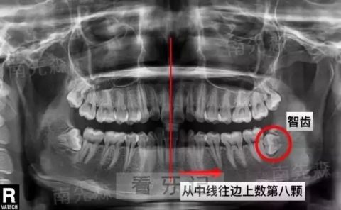 太可怕了！智齿到底长什么样？拔出来的智齿图片照片