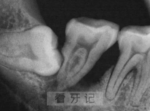 太可怕了！智齿到底长什么样？拔出来的智齿图片照片