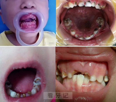 太可怕了牙齿都被虫子吃光了儿童严重龋齿图片