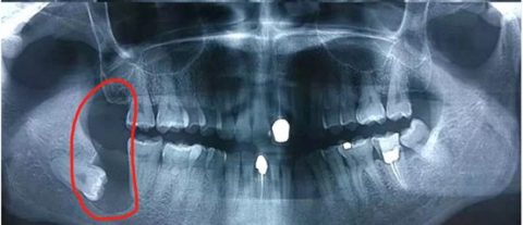 太可怕了！智齿到底长什么样？拔出来的智齿图片照片
