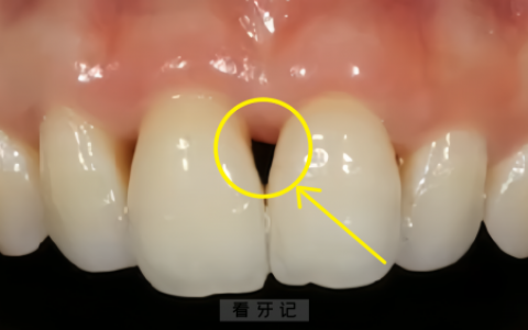 什么是牙齿“黑三角”附高清黑三角图片及正常牙龈图片