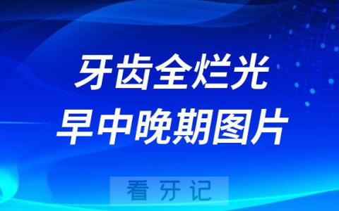 太可怕了儿童龋齿牙齿全烂光早中晚期图片