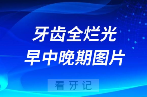 太可怕了儿童龋齿牙齿全烂光早中晚期图片