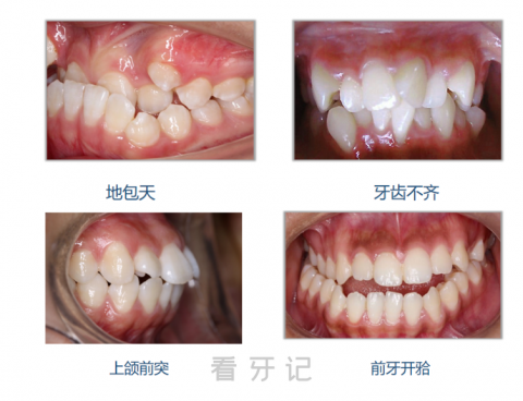 龅牙地包天遗传最新高清图片