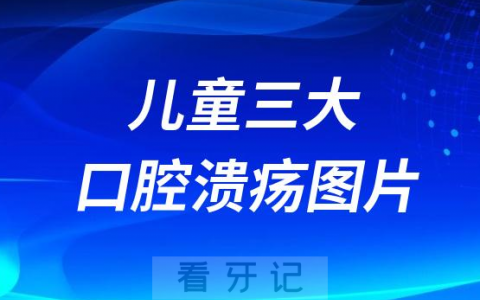 太可怕了！儿童三大口腔溃疡图片