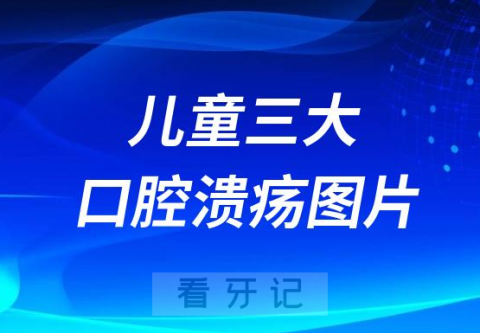 太可怕了！儿童三大口腔溃疡图片