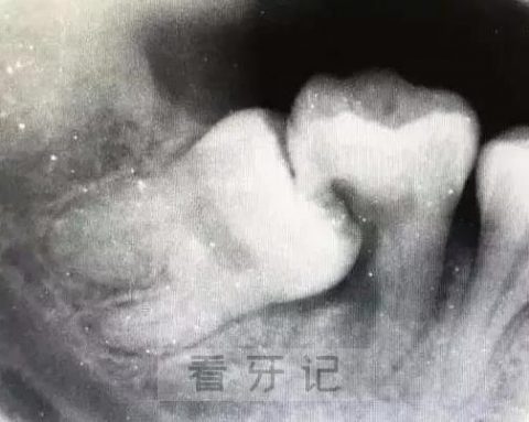 太可怕了！智齿到底长什么样？拔出来的智齿图片照片