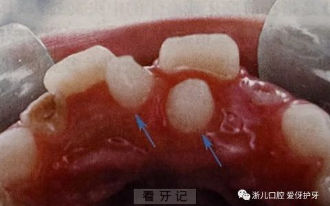 孩子长出两排牙多生牙真实图片