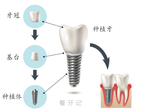 种植牙结构示意图片