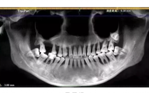 太可怕了！二三十岁年轻人得牙周炎图片