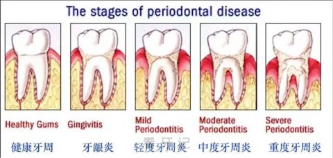 轻度牙周炎中度牙周炎重度牙周炎图片