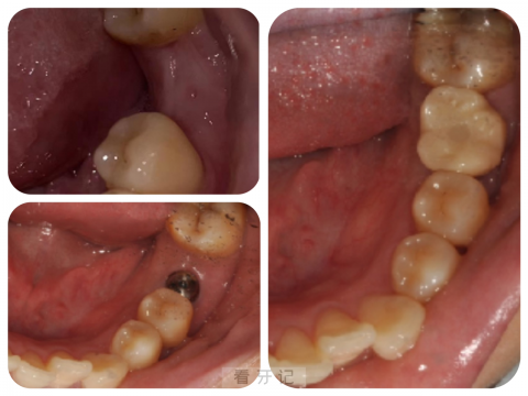 渡江口腔医院24岁小姐姐做种植牙看牙记