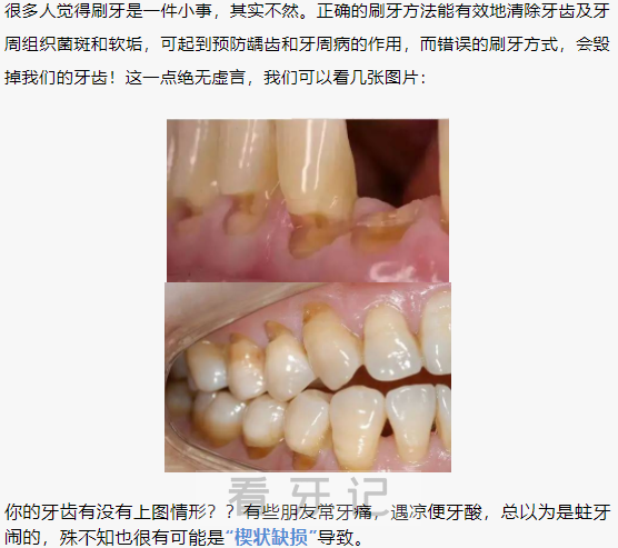 楔状缺损轻度中度重度真人对比图片