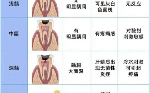 轻度中度重度蛀牙龋齿图解