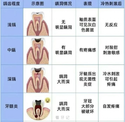 轻度中度重度蛀牙龋齿图解