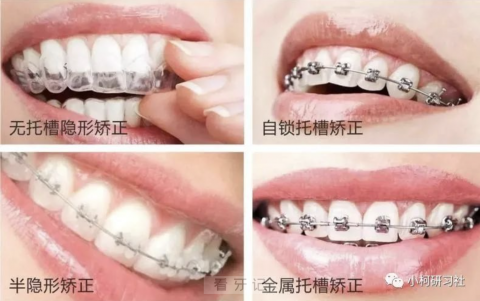 常见的四大牙齿正畸矫正盘点，看看你适合哪个？