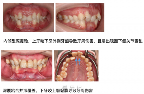 深覆合很可怕吗？一度二度三度定义是什么？附完整对比图