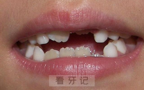 中国十大常见儿童牙齿问题有哪些？最新盘点来了