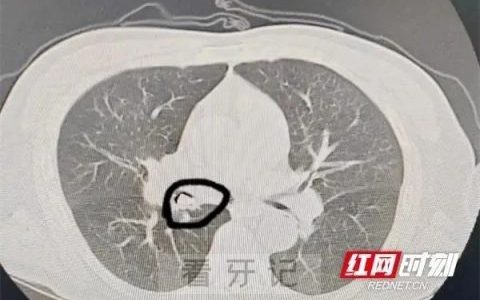 太可怕了！老掉牙竟然会导致重度肺炎