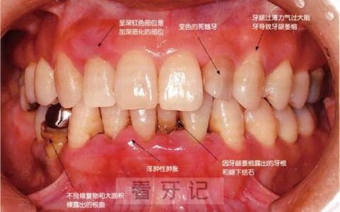牙周炎症状有哪些？最新图片解读