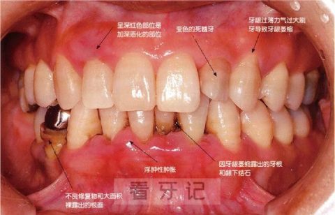 牙周炎症状有哪些？最新图片解读