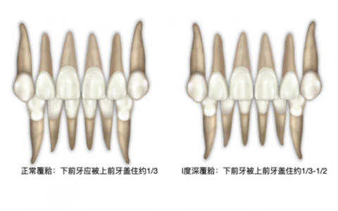 深覆合很可怕吗？一度二度三度定义是什么？附完整对比图