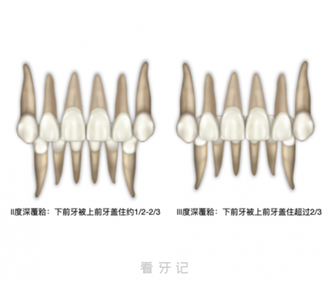 深覆合很可怕吗？一度二度三度定义是什么？附完整对比图