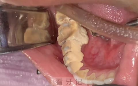 牙结石长什么样？真实图片太恶心了！