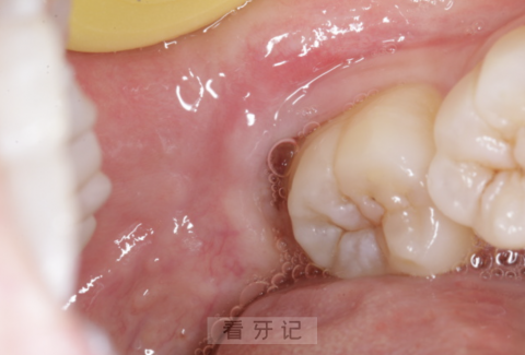 嗓子前面的肉疼是什么导致的？听听牙科医生怎么说