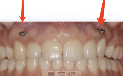 对支抗钉有强烈的恐惧感怎么办？权威解读来了
