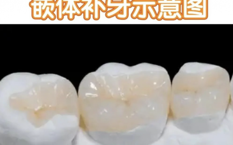 嵌体补牙与高嵌体补牙区别在哪里？最新解读来了