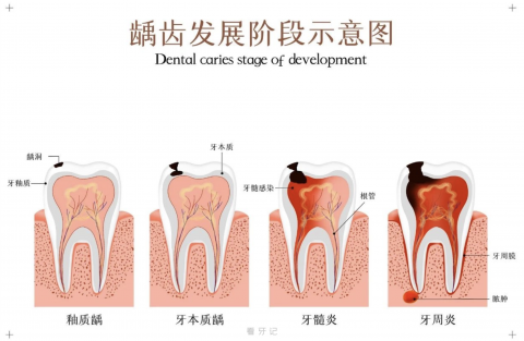 蛀牙三大阶段有哪些？看看你在哪个阶段