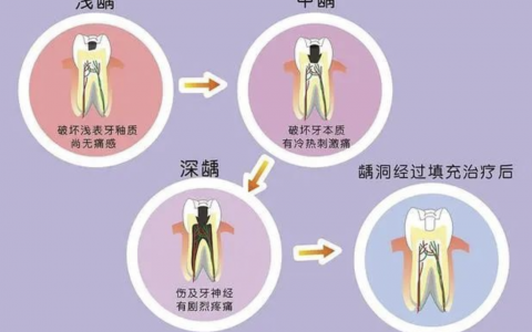 龋齿蛀牙从轻到重发展示意图片