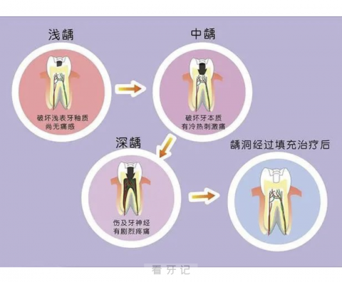 龋齿蛀牙从轻到重发展示意图片