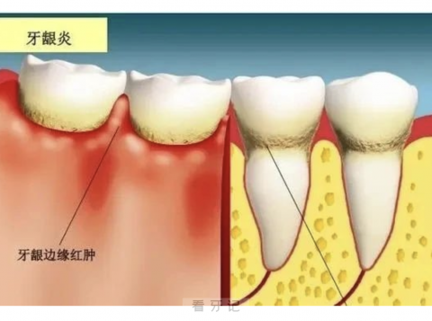 牙龈炎示意图片