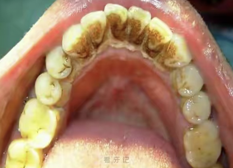 牙龈下面黄黄臭臭的是什么东西？图片来了