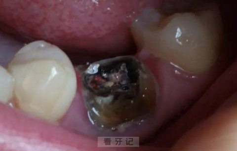 烂牙根导致口腔癌 ？最新案例来了