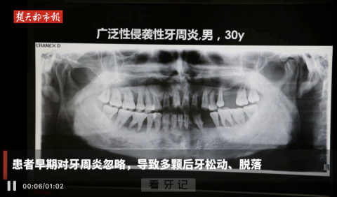 太可怕了！二十多岁的年轻人牙齿却掉了一半？最新案例来了