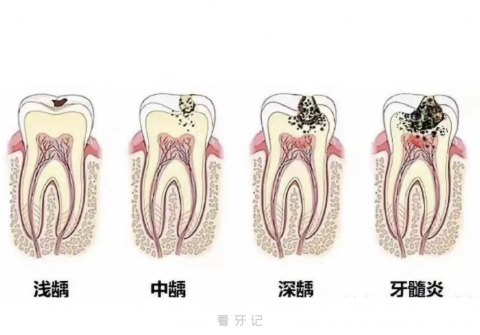 蛀牙烂到牙神经要多长时间？最新图解来了