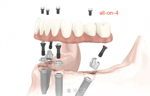 有没有必要做all-on-4/all-on-6种植牙？内行大揭秘来了