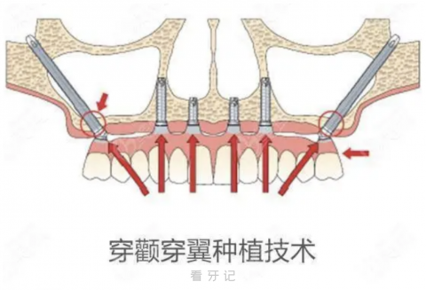太可怕了！穿颧穿翼种植牙六大风险和危害来了