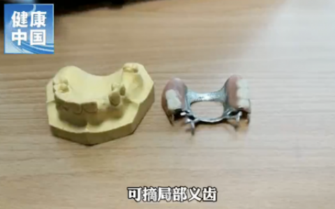 可摘局部义齿是什么东西？最新图片解读来了