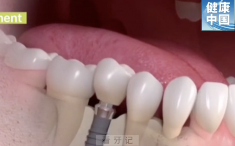 种植义齿是什么东西？最新图片解读来了