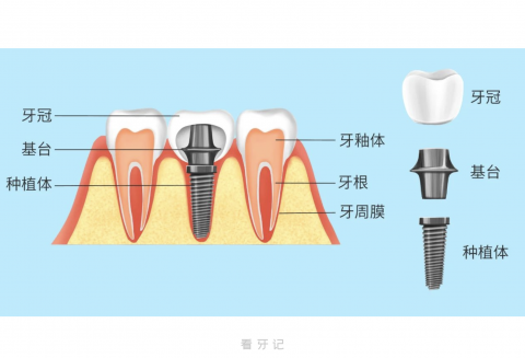 种植牙是怎么种出来的？最新图片解读来了