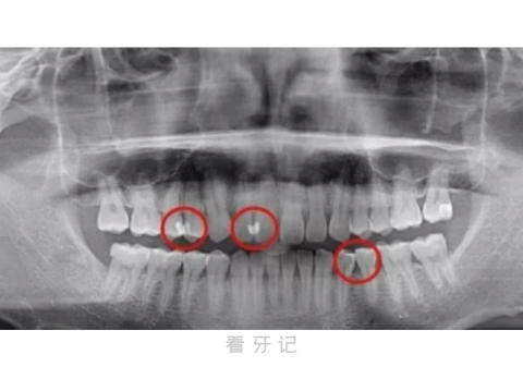 邻面龋长什么样？图片来了