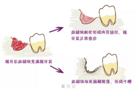 太神奇了！拔牙24小时到7天内的伤口变化