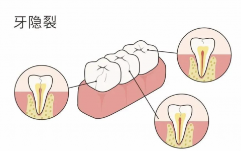 牙隐裂是什么？最新图片解读来了