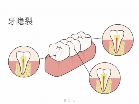 牙隐裂是什么？最新图片解读来了