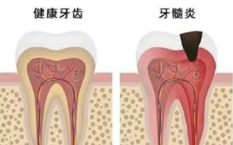 良心医生告诉你吃药治不好牙髓炎