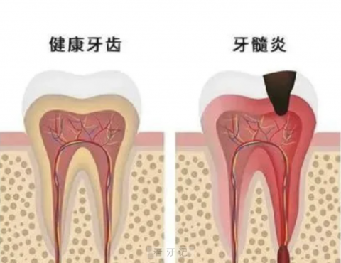 良心医生告诉你吃药治不好牙髓炎